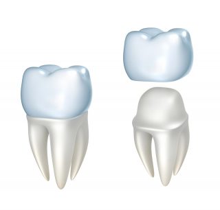 Dental crowns in Harrow