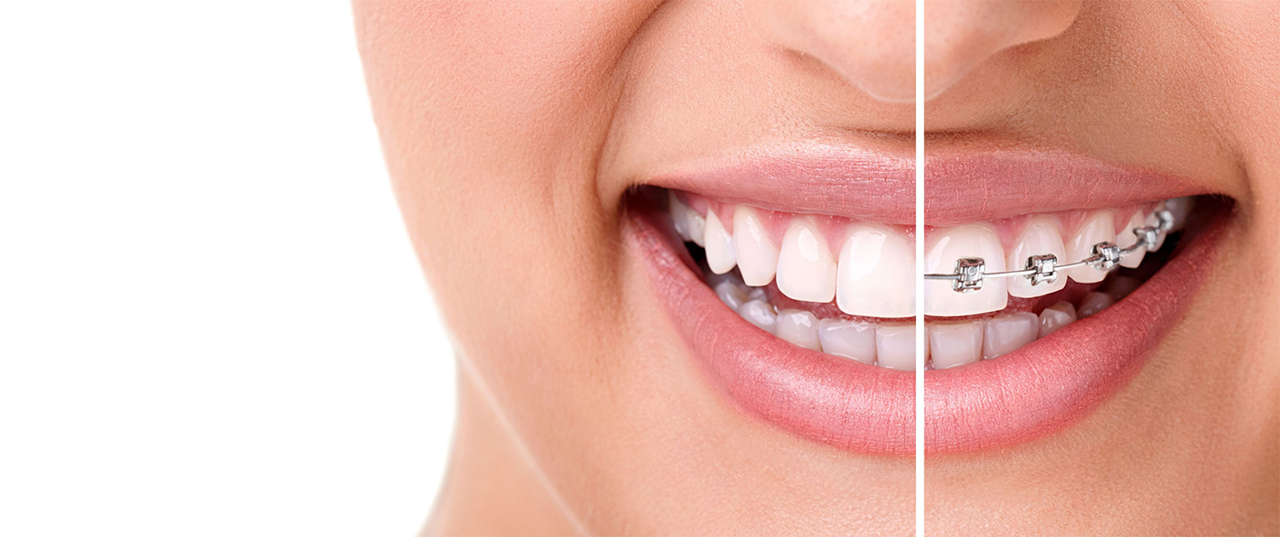Benefits of Invisalign Braces in Harrow