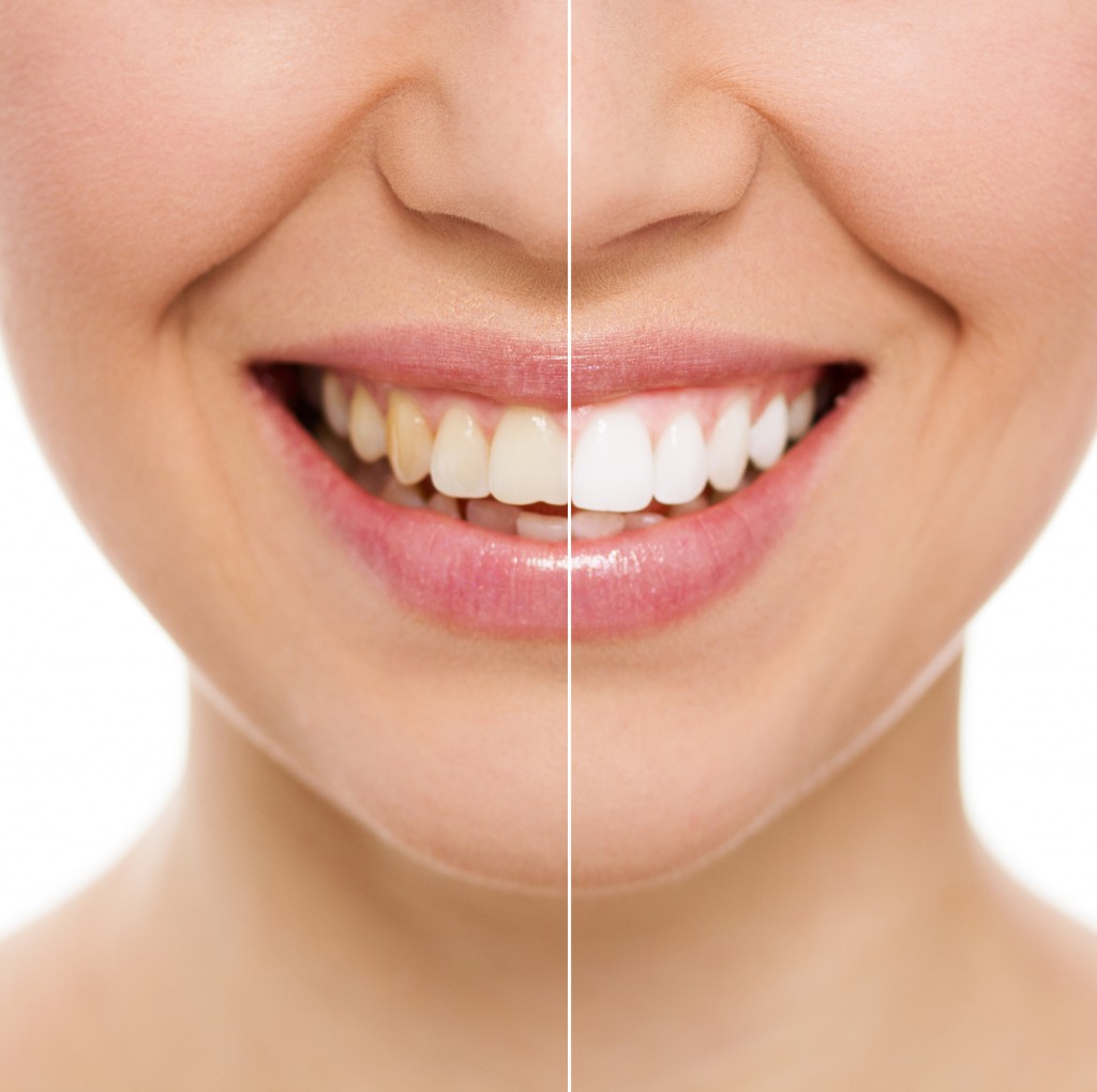 Generic-dentist_SMM_teeth-stain-before-after_20180131.jpg